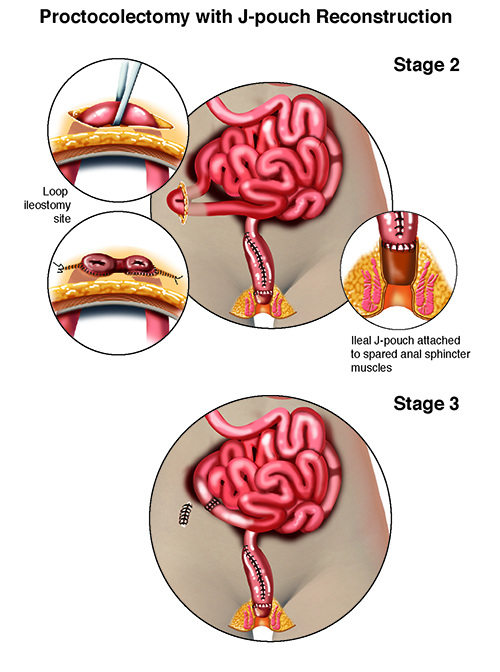 Final stages of proctocolectomy surgery.